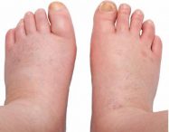 Bengkak kaki semasa hamil