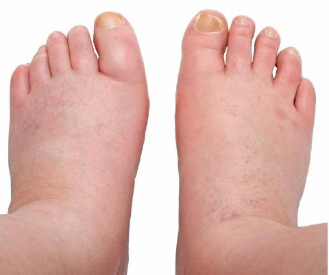 Bengkak kaki semasa hamil