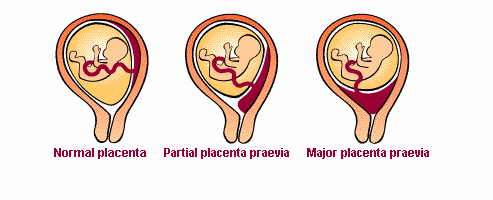 placenta previa