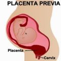 Placenta Previa