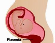 Placenta Previa