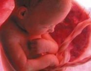 Pengalaman Placenta Previa