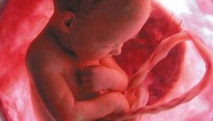 Pengalaman Placenta Previa